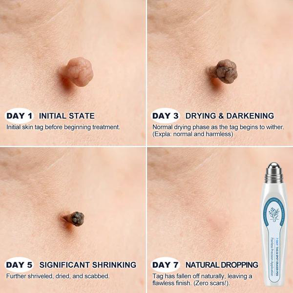 🎁 FREE GIFT — 7-𝐷𝑎𝑦 𝗧𝐚𝐠 & 𝗦𝗽𝐨𝐭 𝐄𝐫𝒂𝒔𝒆𝒓 Serum Pen