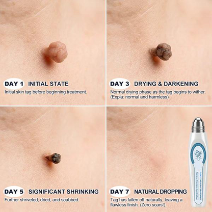 🎁 FREE GIFT — 7-𝐷𝑎𝑦 𝗧𝐚𝐠 & 𝗦𝗽𝐨𝐭 𝐄𝐫𝒂𝒔𝒆𝒓 Serum Pen