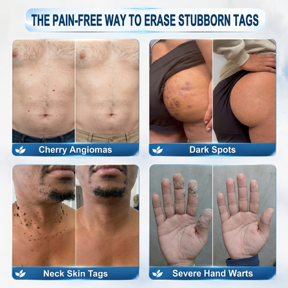 🎁 FREE GIFT — 7-𝐷𝑎𝑦 𝗧𝐚𝐠 & 𝗦𝗽𝐨𝐭 𝐄𝐫𝒂𝒔𝒆𝒓 Serum Pen